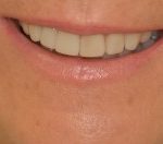 Smile Makeovers at Dental Excellence Ireland - After 2. Smile Makeovers at Dental Excellence Ireland - After 2
