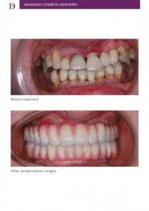 Before & after dental implant surgery. Before & after dental implant surgery