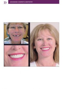 What to do when you lose a tooth?