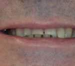 Smile Makeovers at Dental Excellence Ireland - Before. Smile Makeovers at Dental Excellence Ireland - Before