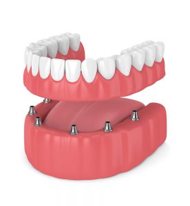 Implant over-denture. Implant over-denture