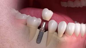 Are you missing a tooth or teeth?