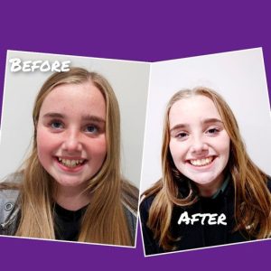 Patient before and after case study 1