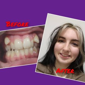 Patient before and after case study 2