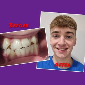 Patient before and after case study 5