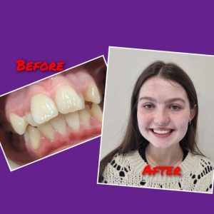 Patient before and after case study 6. Patient before and after case study 6
