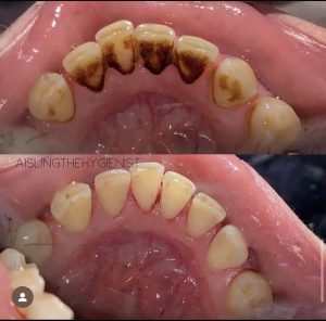 Patient before and after case study 9. Patient before and after case study 9