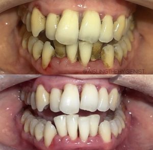 Patient before and after case study 11. Patient before and after case study 11